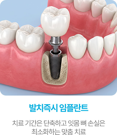 발치즉시 임플란트