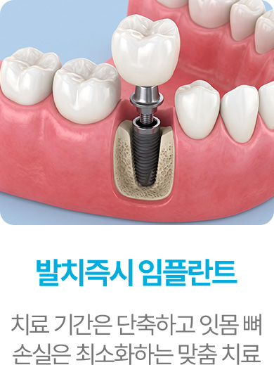 발치즉시 임플란트