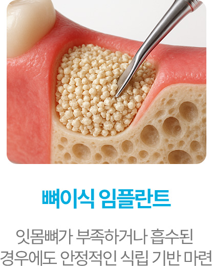 뼈이식 임플란트
