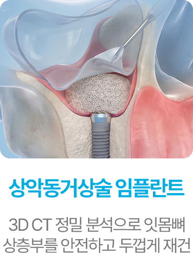 상악동거상술 임플란트
