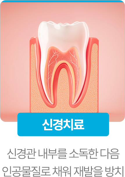 신경치료