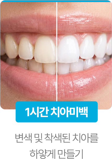 1시간치아미백