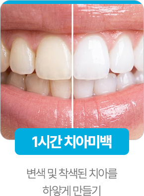 1시간치아미백