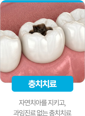 충치치료